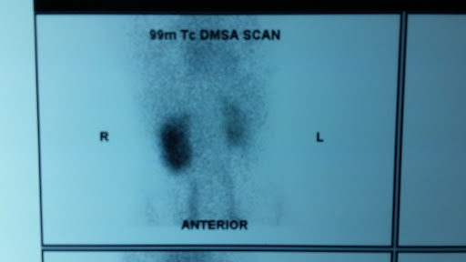 DMSA renal scan 