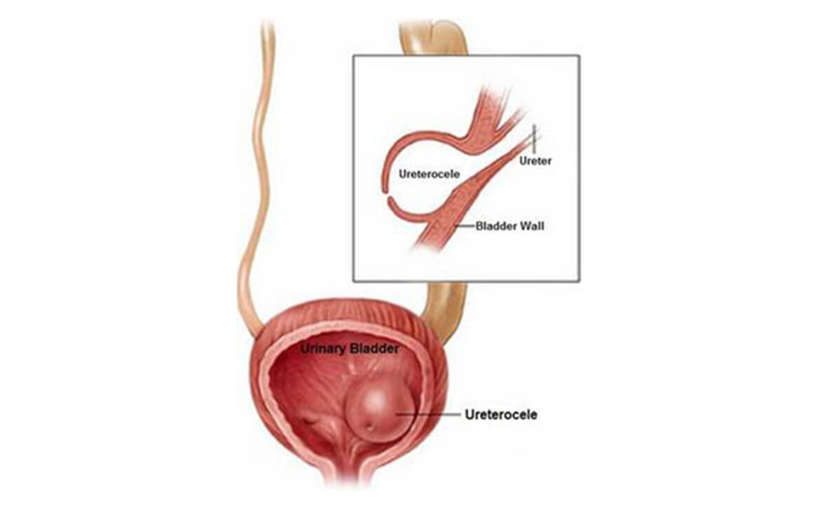 Best Pediatric Urologist in India, Robotic pediatric urology