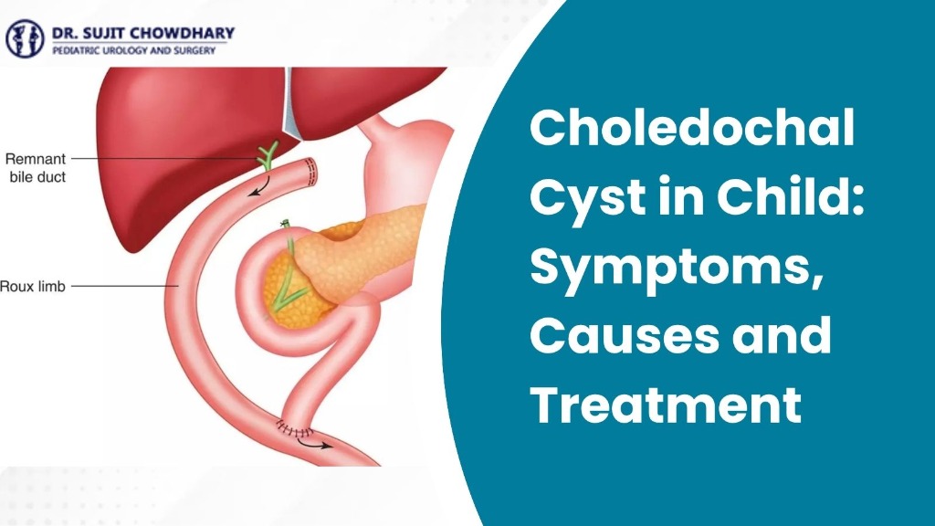 Choledochal Cyst in Child: Symptoms, Causes and Treatment