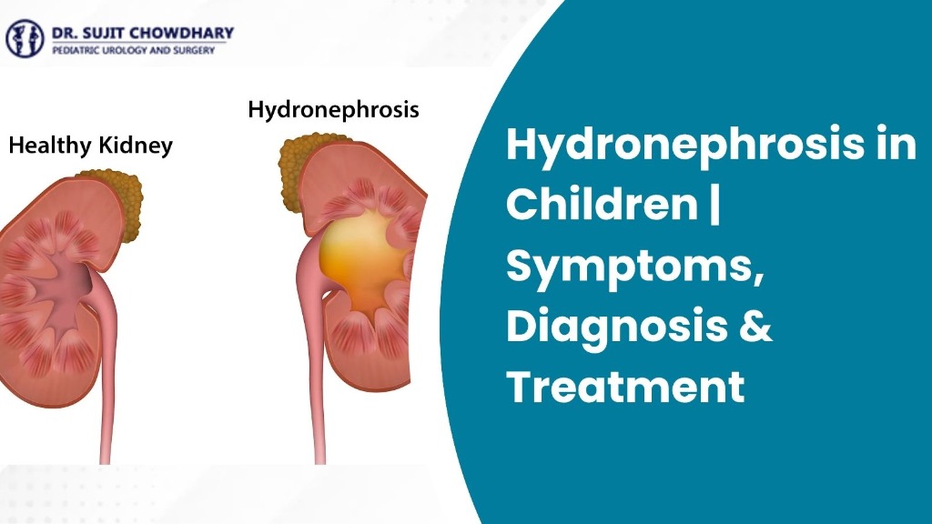 Hydronephrosis in Children | Symptoms, Diagnosis & Treatment