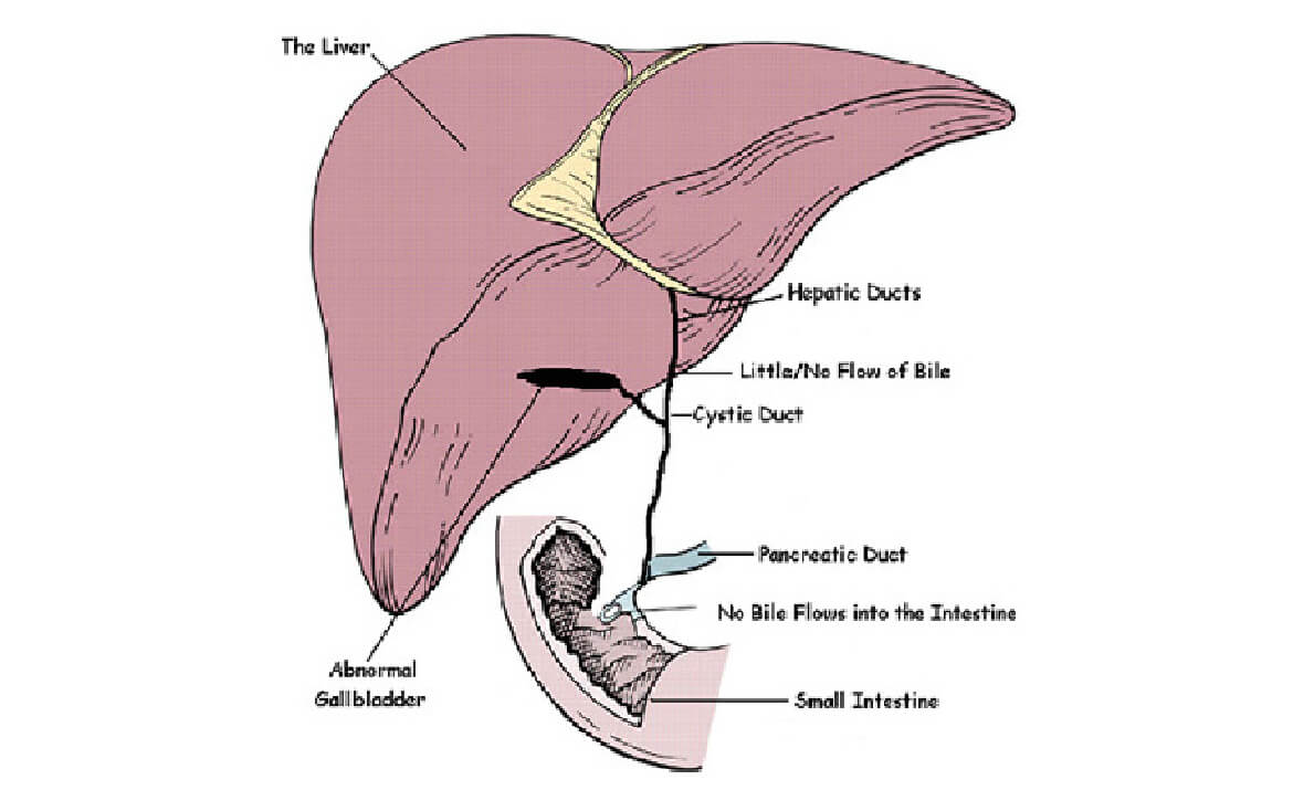 Extra Hepatic Biliary Atresia (EHBA), gastroenterologist surgeon in India