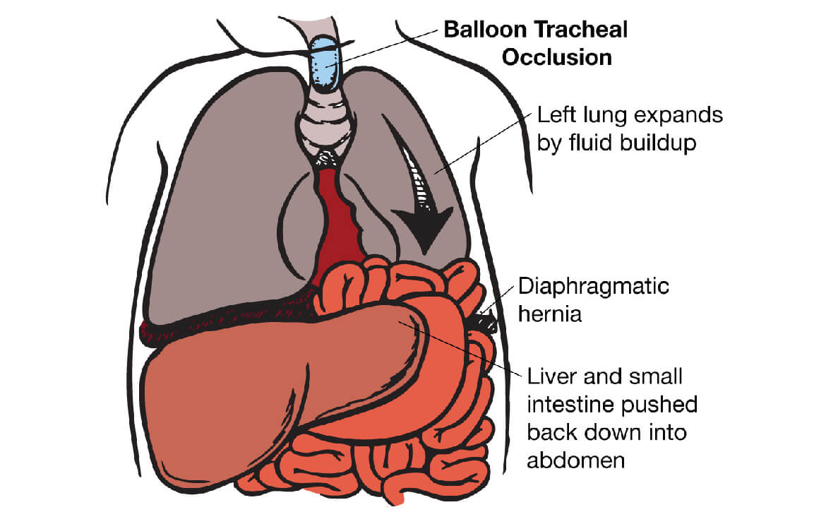 Congenital Diaphragmatic Hernia (CDH), gastroenterologist surgeon in India