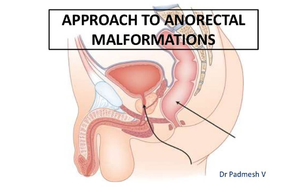 High  Anorectal Malformation (ARM), gastroenterologist surgeon in India