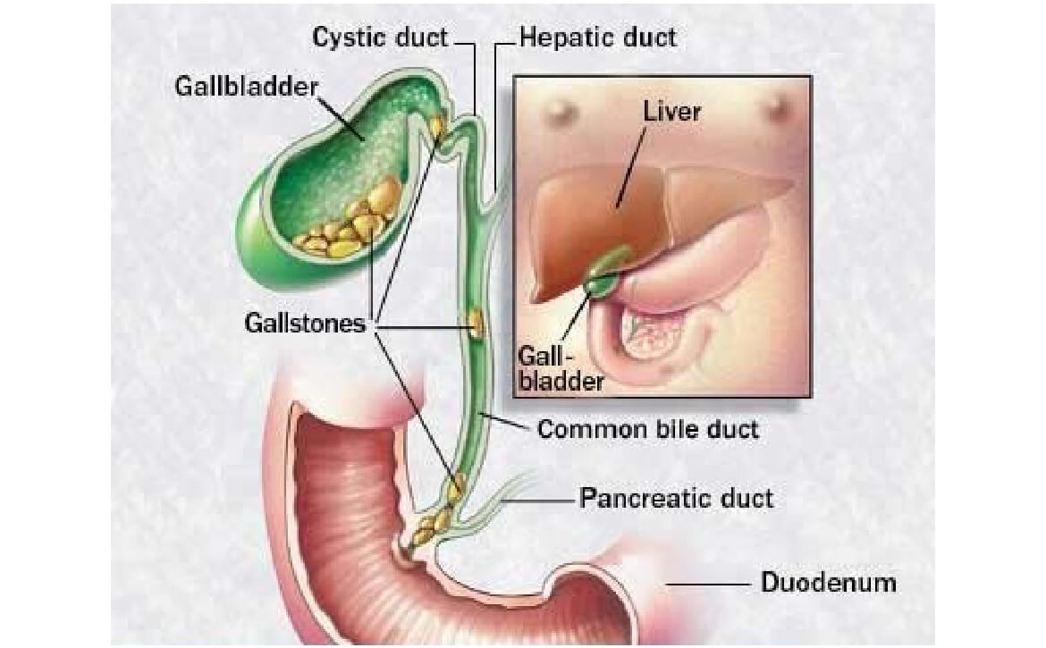 Laparoscopic Cholecystectomy, gastroenterologist surgeon in India