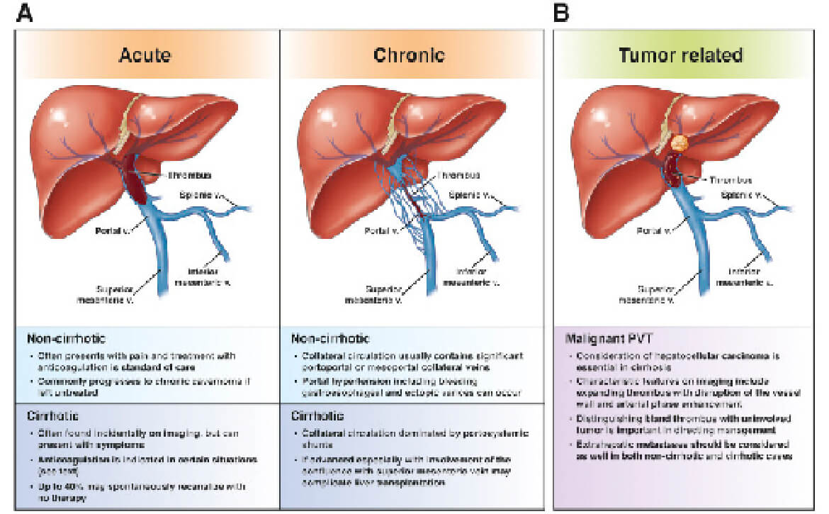 Extrahepatic portal Vein Obstruction with Portal Hypertension