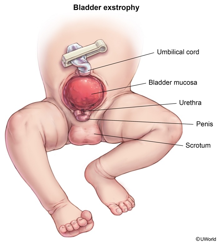 Bladder Exstrophy Medical Diagram