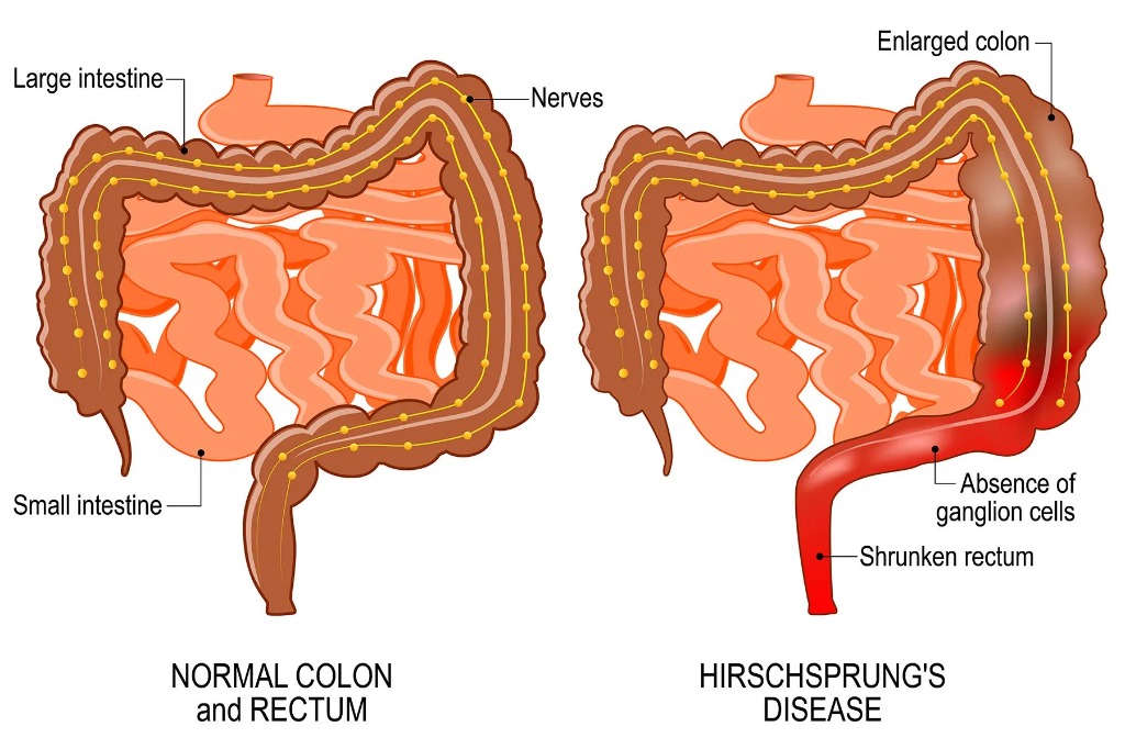 Normal Colon and Rectum vs Hirschsprung's Disease Diagram