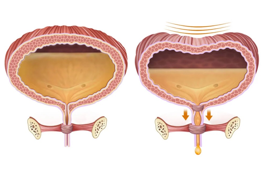 Normal Bladder vs Neuropathic Bladder Dysfunction Diagram