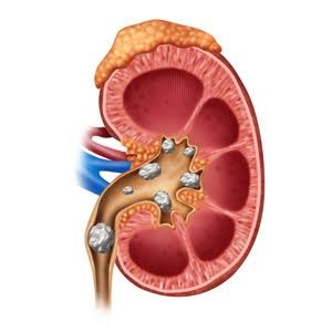 Kidney Stones Medical Diagram