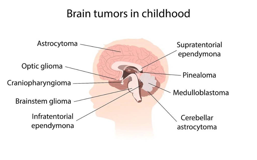Brain Tumors in Childhood Diagram