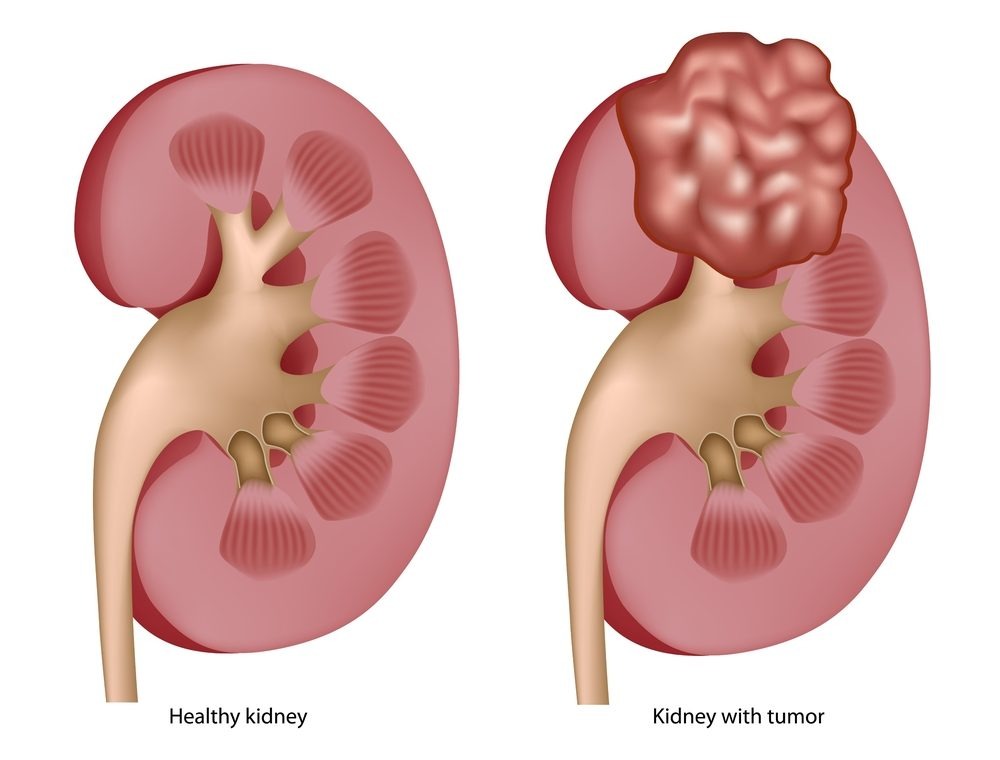 Healthy Kidney vs Kidney with Tumor Diagram