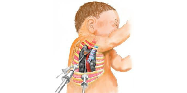 Pediatric Thoracoscopic Surgery Trocar Diagram
